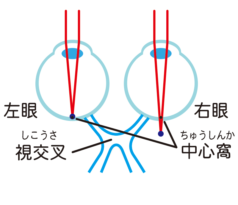 不同視弱視