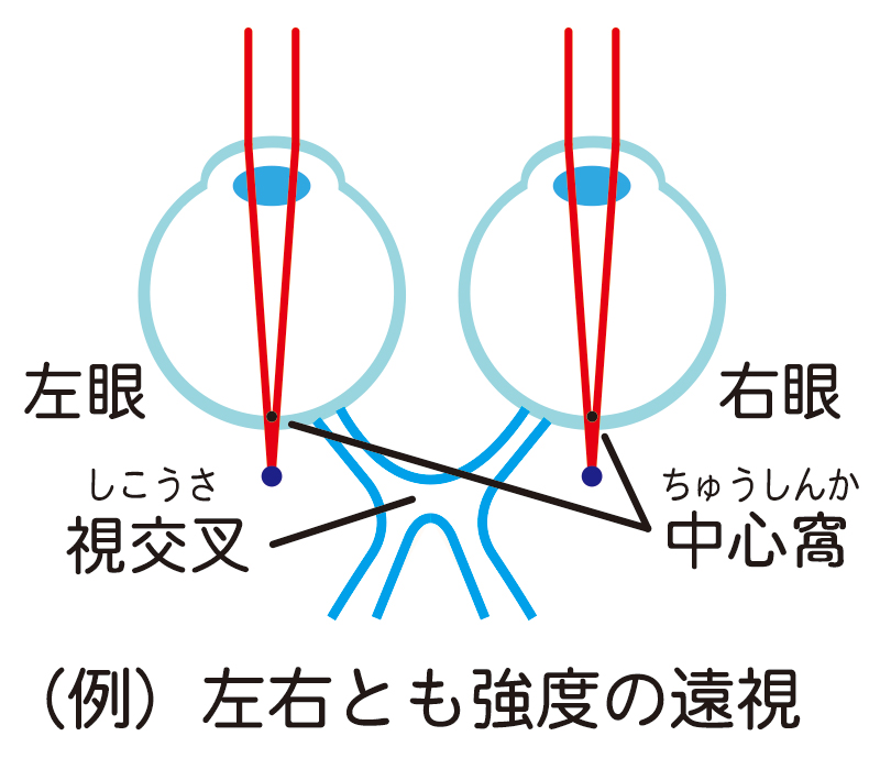 屈折異常弱視