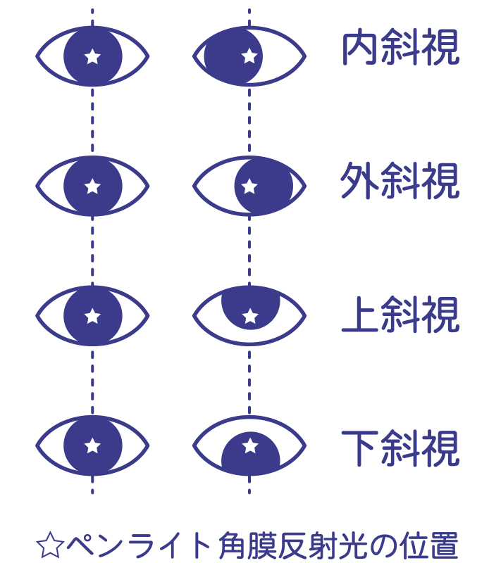 斜視弱視