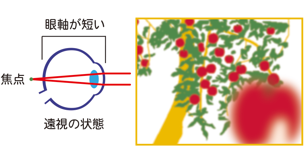 遠視