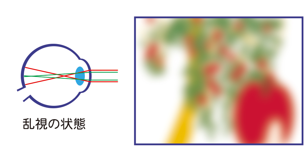 乱視